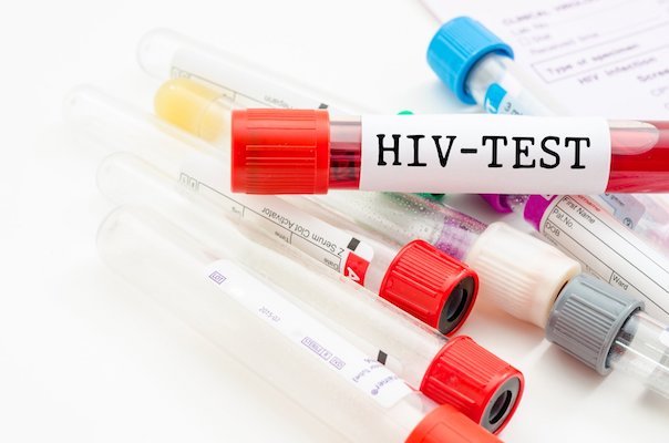 Из-за карантина число тестов на ВИЧ в апреле упало на 30%